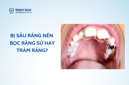 Bị sâu răng nên bọc răng sứ hay hàn trám răng?