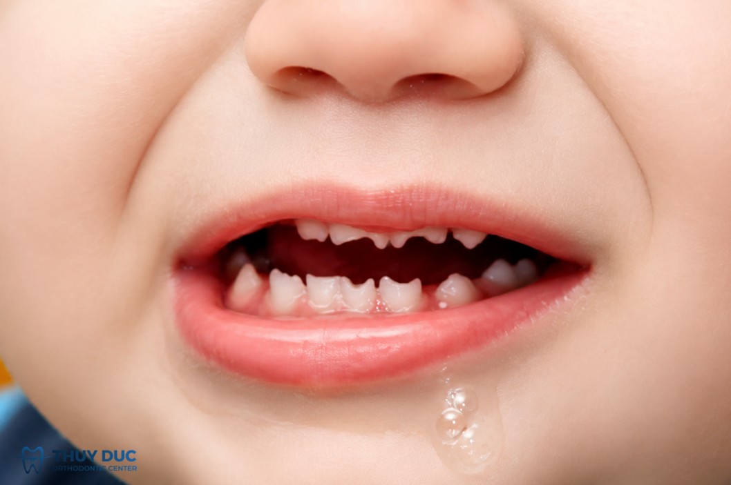 Răng dâu tằm khác răng cửa Hutchinson như thế nào? 1 Răng dâu tằm khác răng cửa Hutchinson như thế nào? 1