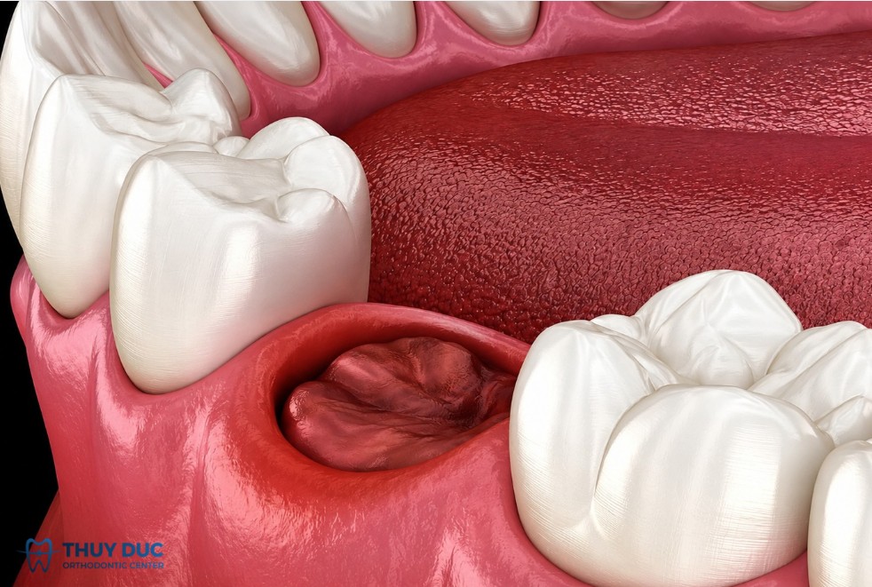 Tăng nguy cơ viêm ổ răng khô (dry socket / alveolar osteitis) 1 Tăng nguy cơ viêm ổ răng khô (dry socket / alveolar osteitis) 1