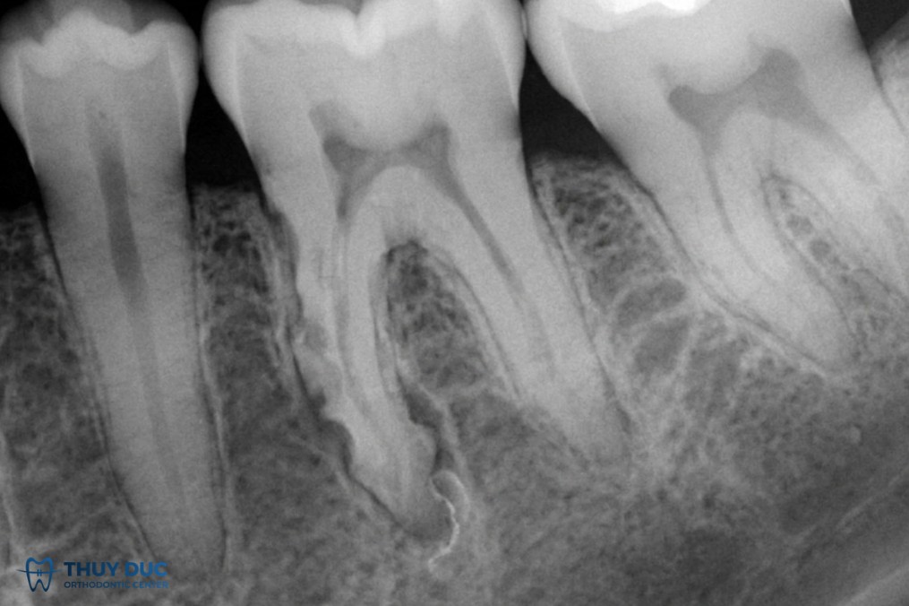 3. Tiêu chân răng đáng kể trên phim X-quang 1 3. Tiêu chân răng đáng kể trên phim X-quang 1