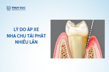 Vì sao áp xe nha chu lại tái phát nhiều lần?