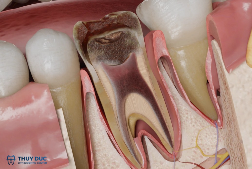 Chiều ngược lại: Khi bệnh lý răng gây ra viêm xoang 1 Chiều ngược lại: Khi bệnh lý răng gây ra viêm xoang 1