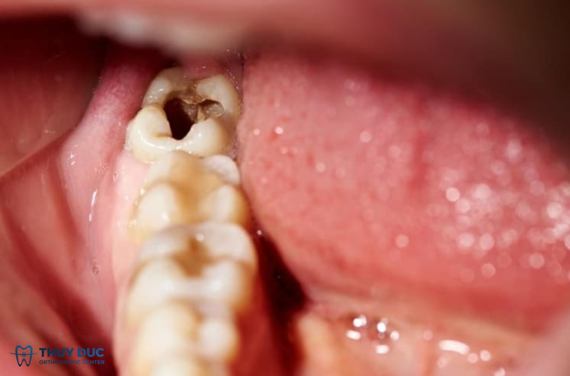 Nhổ răng khôn khi nào là cần thiết? 1 Nhổ răng khôn khi nào là cần thiết? 1