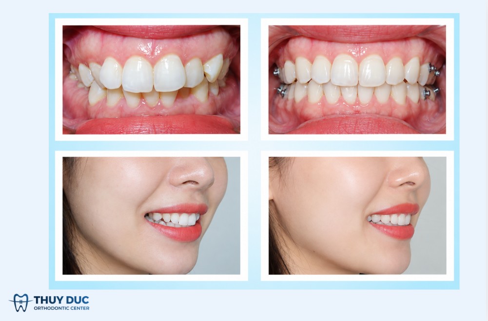 Nếu đang định niềng thì nên bọc sứ trước hay sau? 1 Nếu đang định niềng thì nên bọc sứ trước hay sau? 1