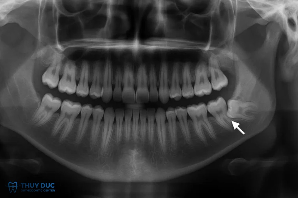 Răng khôn mọc lệch hoặc mọc ngầm có bắt buộc phải nhổ? 1 Răng khôn mọc lệch hoặc mọc ngầm có bắt buộc phải nhổ? 1