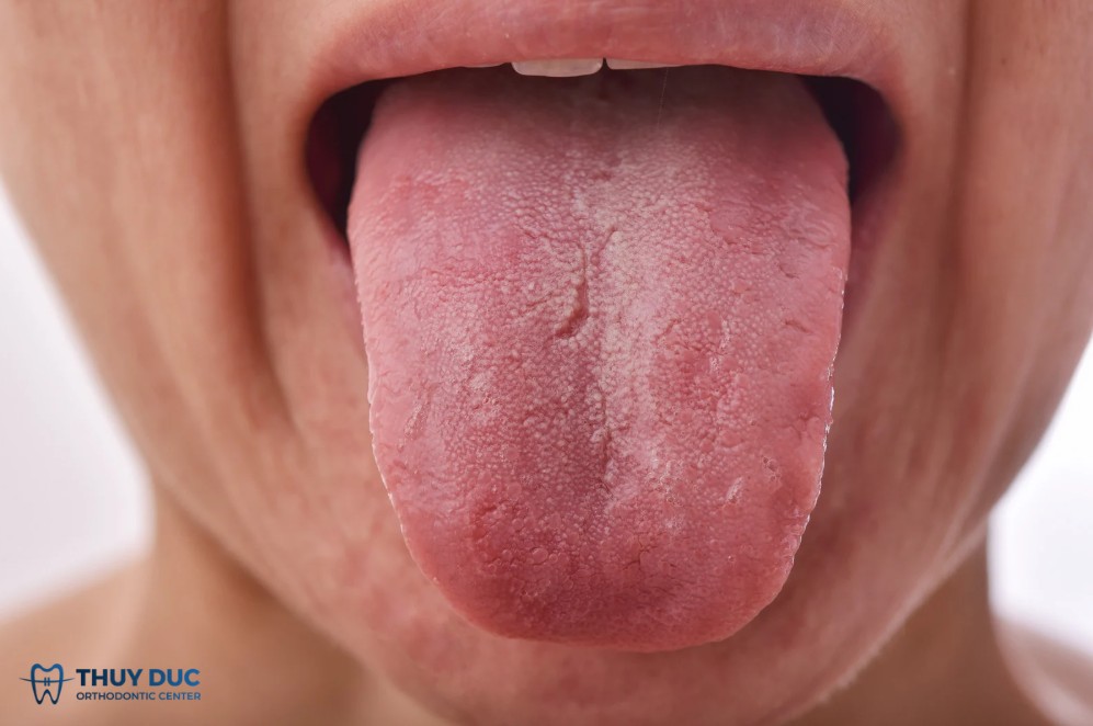 Vị kim loại kéo dài có ảnh hưởng gì không? 1